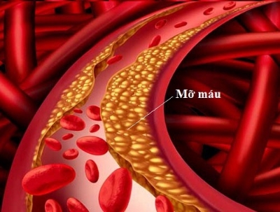 Triệu chứng và biến chứng của mỡ máu không phải ai cũng biết